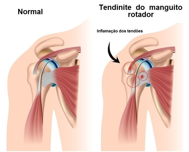 Tendinopatia do Manguito Rotador: dor no ombro - Clínica Dr. Hong Jin Tendinopatia do Manguito Rotador: dor no ombro - Clínica Dr. Hong Jin