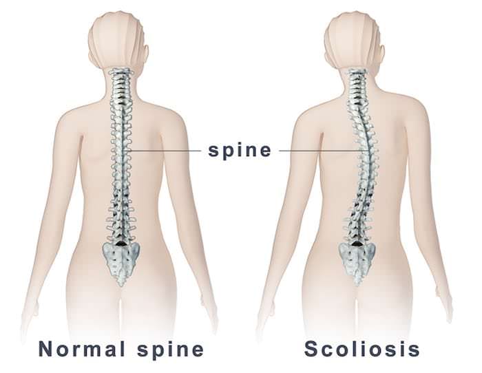 escoliose