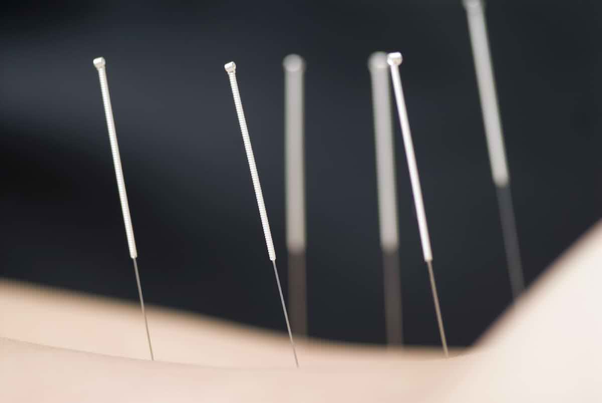 9 Razões Para Você Fazer Acupuntura.