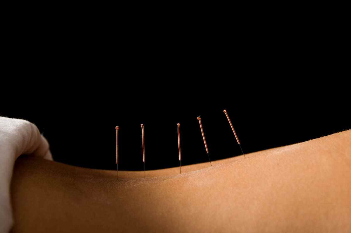 Acupuntura pode prevenir boca seca (xerostomia) induzida por radioterapia, segundo estudo