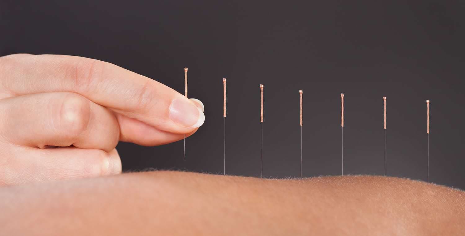 5 Benefícios da Acupuntura