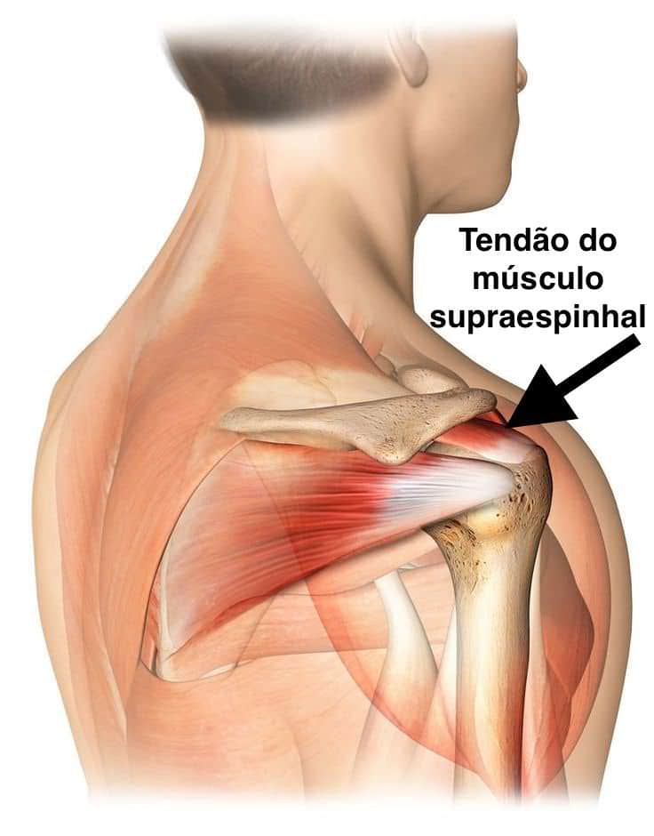 tendao-do-supraespinhal.jpg