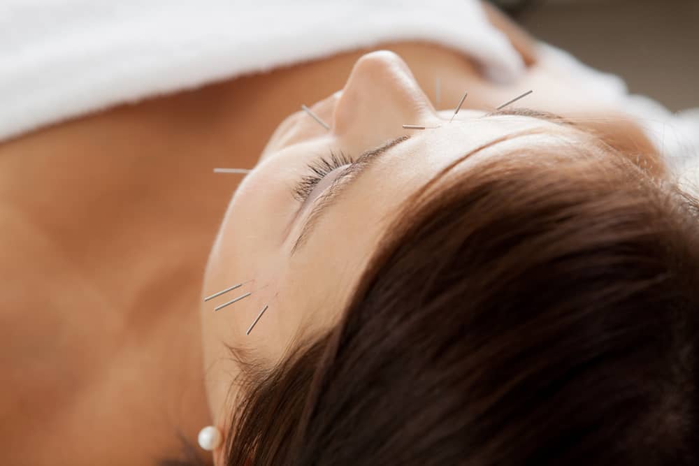 acupuntura stress