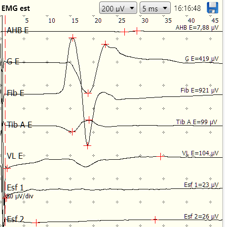 EMG estimulada