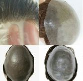 Próteses Capilar Masculina em Silicone