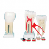 Dente Molar Ampliado c/ Evolução da Cárie em 8 Partes-CS/AT/TGD-0311-G
