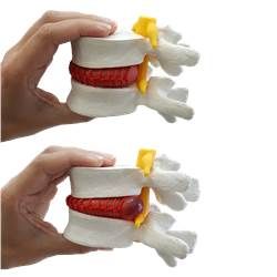 Modelo Funcional de Prolapso Intervertebral-CS/AT/TGD-0153-P