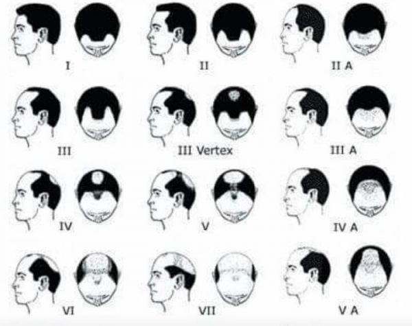 Proteses Capilar Masculina sob medida