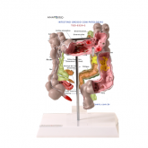 Intestino Grosso c/ Patologia-CS/AT/TGD-0329-G