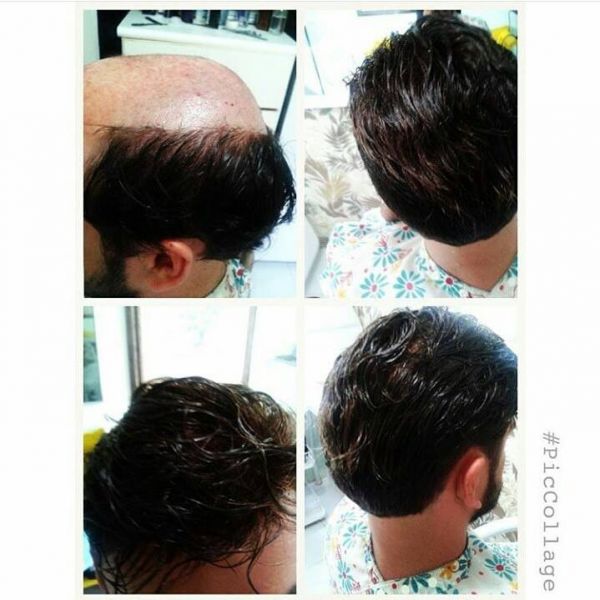 Proteses Capilar Masculina tradicional