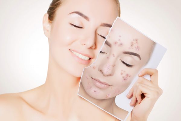 Tratamento para acne
