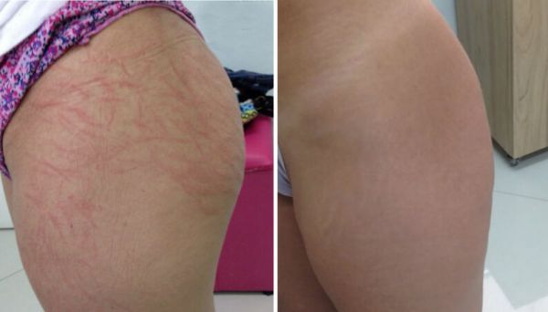 Tratamento para estrias