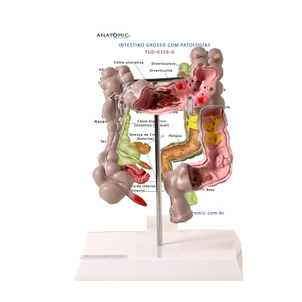 Intestino Grosso c/ Patologia-CS/AT/TGD-0329-G