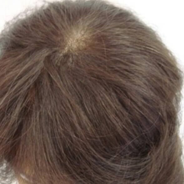 Próteses Capilar natural Micropele perfeita para cobertura de falhas capilar ou acabamentFeminina