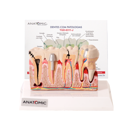 Patologia Dentária e Placa Explicativa em 2 Partes CS/AT/TGD - 0311-J