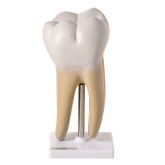 Dente Molar Ampliado Saudável e c/ Cárie-CS/AT/TGD-0311-B