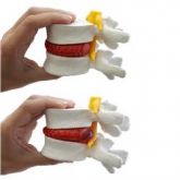 Modelo Funcional de Prolapso Intervertebral-CS/AT/TGD-0153-P