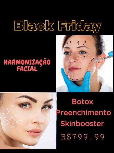 Harmonização Facial