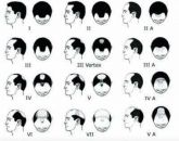Proteses Capilar Masculina sob medida