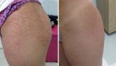 Tratamento para estrias