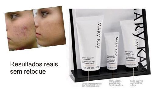 5.Kit Introdutório ao Sistema de Cuidados da Pele com Tendência à Acne