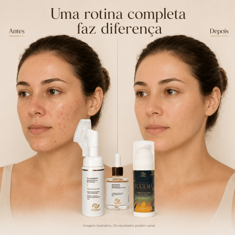 Kit SkinCare para Acne –  Cleanser Mousse + Sérum Facial Antiacne + Creme Facial Tucumã | Rotina Completa de Cuidados com a Pele ALTHER