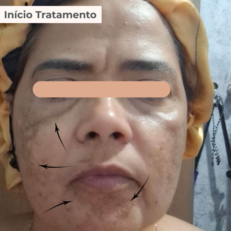 PACK TRATAMENTO 3 MESES BLEND LUMINY ADVANCE SKINCARE