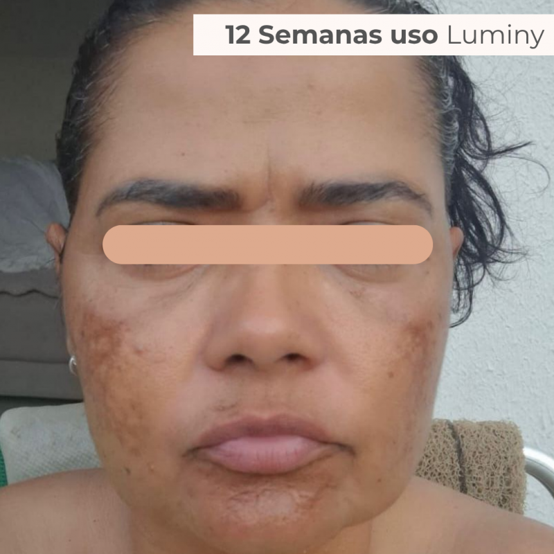 PACK TRATAMENTO 3 MESES BLEND LUMINY ADVANCE SKINCARE