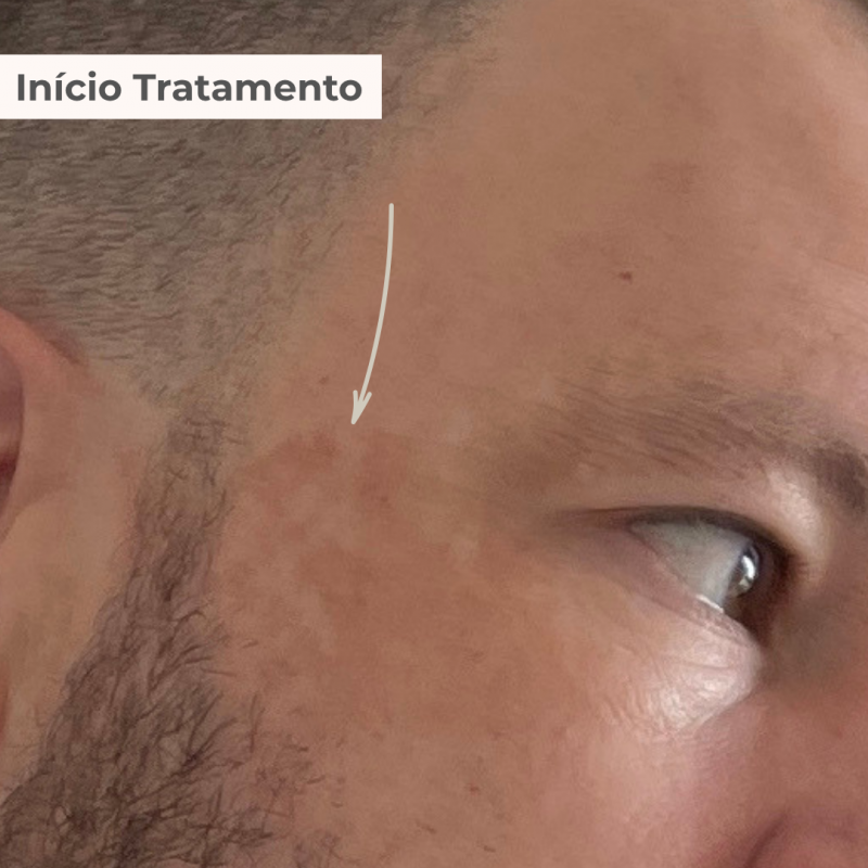 PACK TRATAMENTO 3 MESES BLEND LUMINY ADVANCE SKINCARE