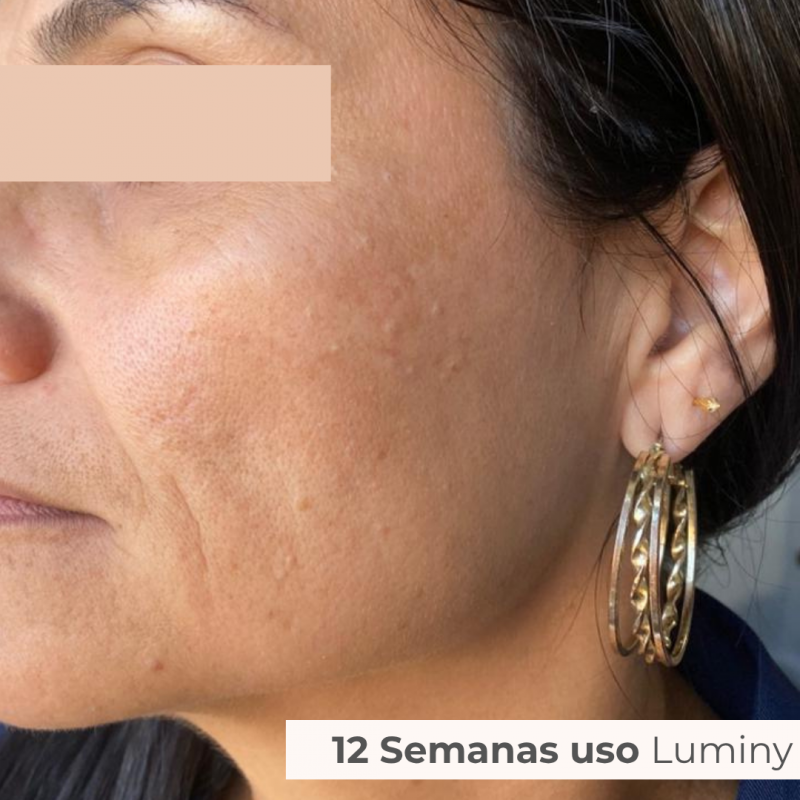 PACK TRATAMENTO 3 MESES BLEND LUMINY ADVANCE SKINCARE