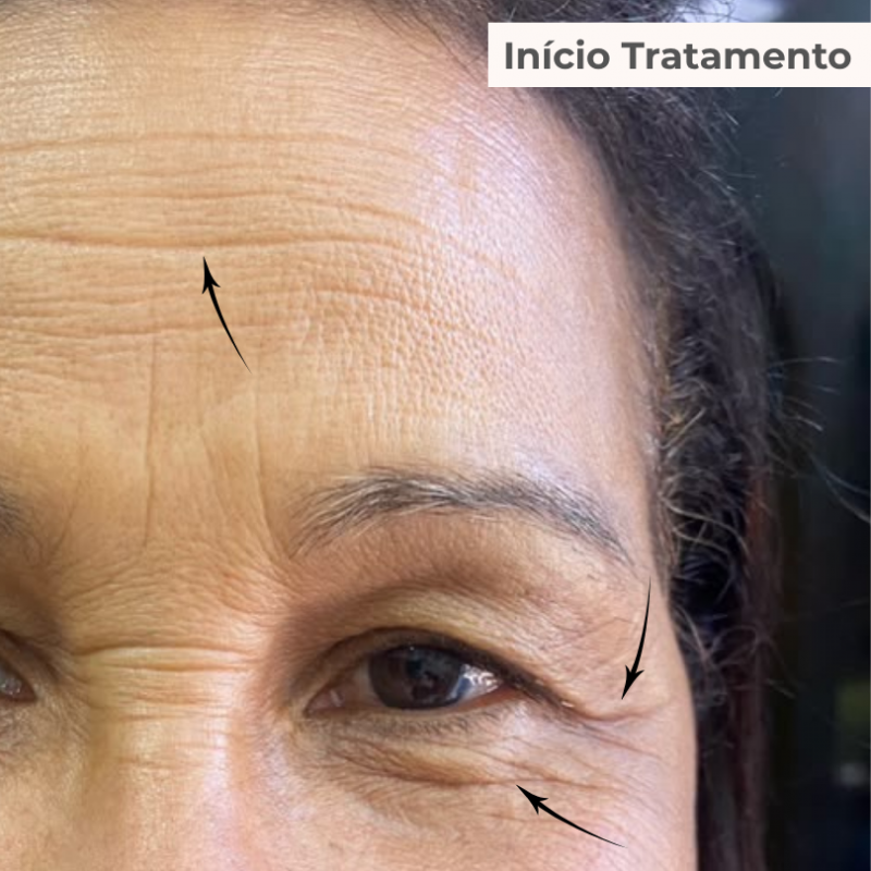 PACK TRATAMENTO 3 MESES BLEND LUMINY ADVANCE SKINCARE