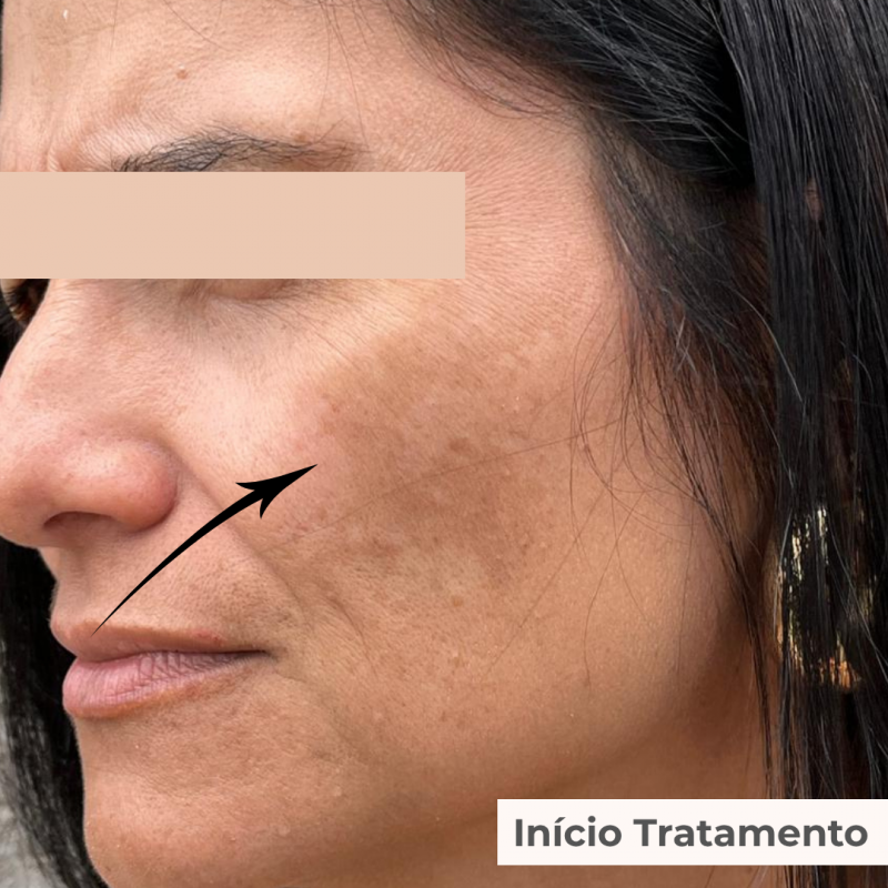 PACK TRATAMENTO 3 MESES BLEND LUMINY ADVANCE SKINCARE