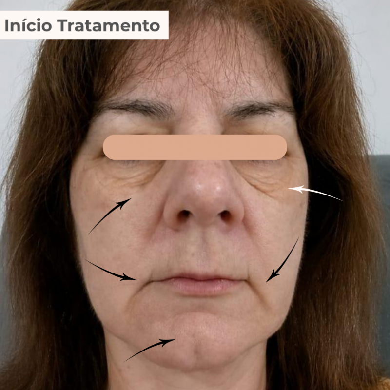 PACK TRATAMENTO 3 MESES BLEND LUMINY ADVANCE SKINCARE