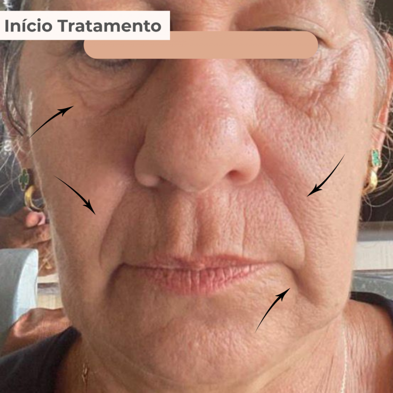 PACK TRATAMENTO 3 MESES BLEND LUMINY ADVANCE SKINCARE