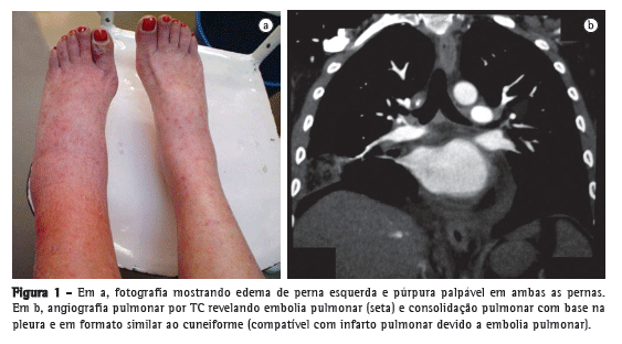 Drenagem da veia diploica frontal
