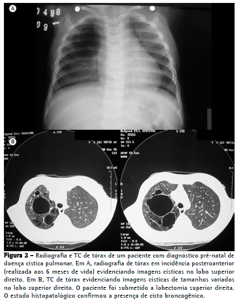 agenesia pulmonar o que é agenesia pulmonar o que é