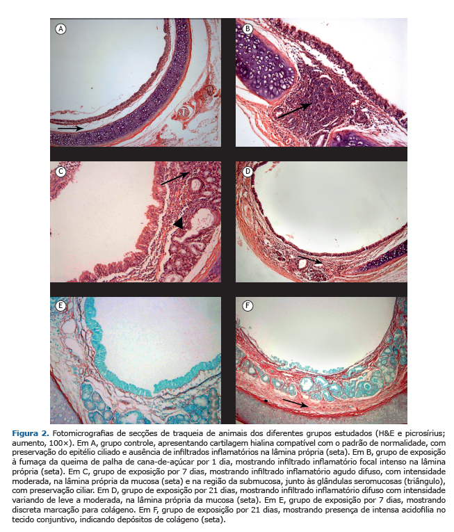síndrome de congestão vascular leve