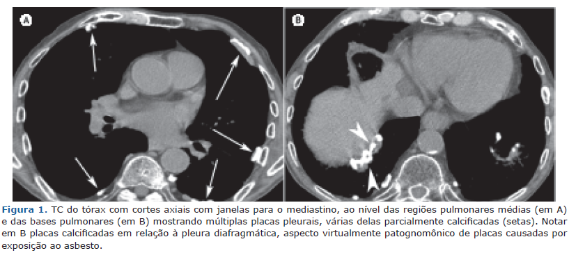 cáncer de próstata y asbesto