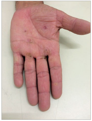 aco hand irritation treatment cream aco hand irritation treatment cream