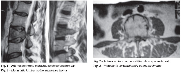 metastasi del melanoma alla prostata