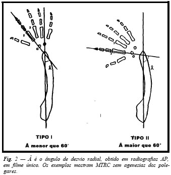 agenesia radial definida