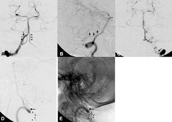 agenesia arco posterior atlas pain agenesia arco posterior atlas pain