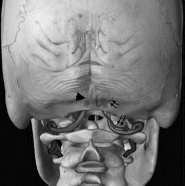 agenesia arco posterior atlas bone
